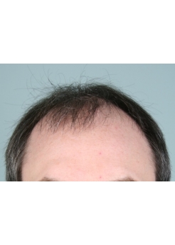 Before Hair Transplant&nbsp;2 Sessions (Areas)